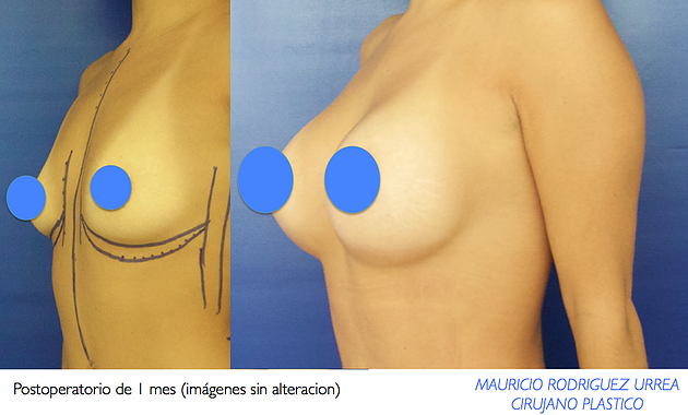Implantes mamarios que duran para siempre