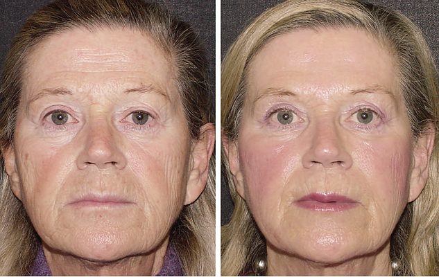La Renovación Facial con Lipoinjertos